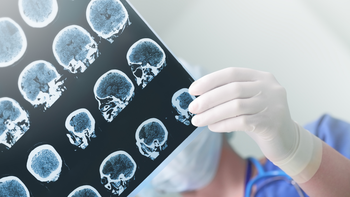 estudio cerebro acv