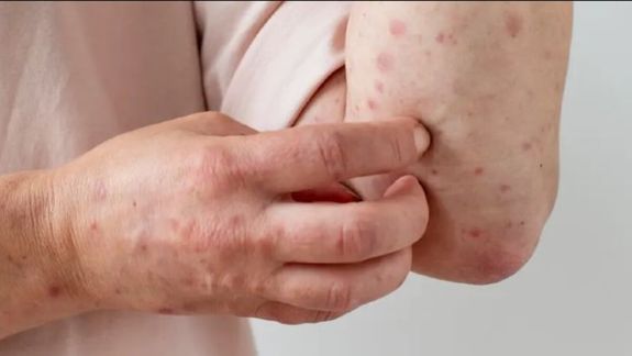 A pesar de estas cifras, los especialistas advierten que podrían encontrarse más casos en los próximos días.