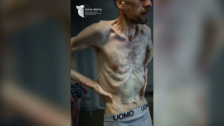 El cuerpo esquelético de Roman Gorilyk, prisionero de guerra ucraniano liberado por Rusia. El cuerpo esquelético de Roman Gorilyk, prisionero de guerra ucraniano liberado por Rusia.