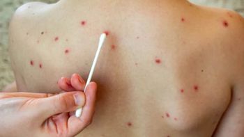 Tras los últimos casos de sarampión detectados en la Argentina, el Ministerio de Salud emitió una alerta sanitaria y recomendó controlarse y vacunarse. Tras los últimos casos de sarampión detectados en la Argentina, el Ministerio de Salud emitió una alerta sanitaria y recomendó controlarse y vacunarse.