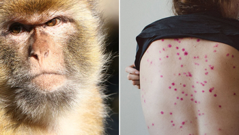 viruela del mono: por el aumento de casos, declaran la emergencia internacional viruela del mono: por el aumento de casos, declaran la emergencia internacional