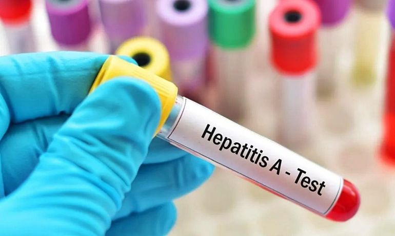 Argentina está en alerta por hepatitis A.