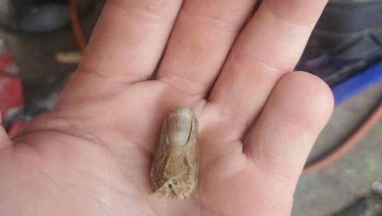 Se cortó un dedo y lo encontró seis meses después