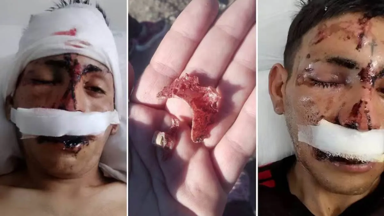 El hombre que recibió el ataque con ladrillazos quedó desfigurado y debió ser hospitalizado.