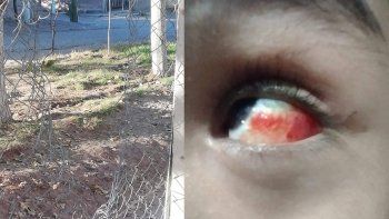 Escuela 354: cómo está la nena que se lastimó un ojo en el alambrado