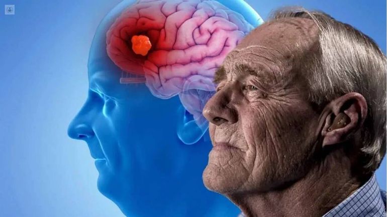 Alzheimer: 5 señales asociadas a la enfermedad, más allá de la memoria