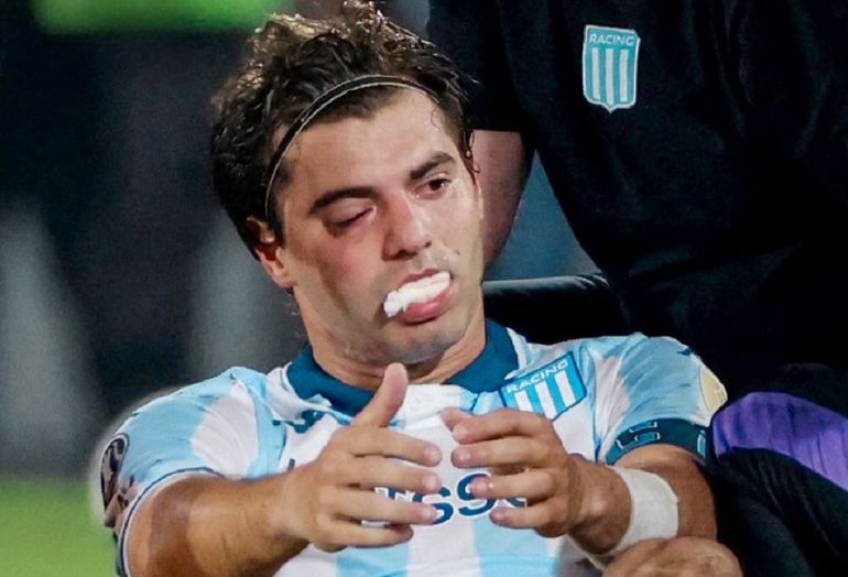 Cómo le quedó el rostro a Santiago Sosa luego de la operación por la fractura que le hizo Marcos Rojo