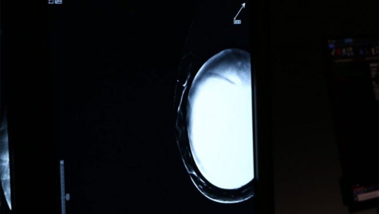 COVID y mamografías: advierten sobre un efecto secundario de las vacunas en los ganglios linfáticos