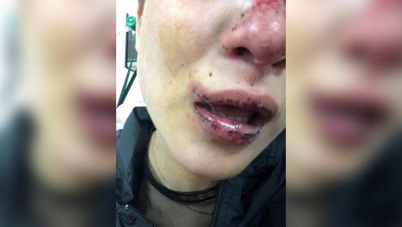 Violencia de género: la esperó afuera del boliche y la desfiguró