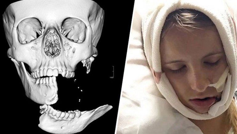 Su mandíbula quedó colgando de un hilo de piel tras caerse de su caballo