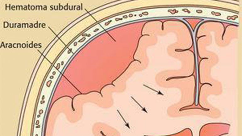 hematoma subdural que une las venas