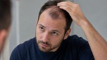 La caída del pelo aparece como un posible efecto en personas que usan inyecciones para adelgazar. La caída del pelo aparece como un posible efecto en personas que usan inyecciones para adelgazar.
