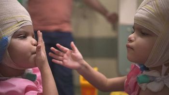 Las siamesas separadas en Brasil se recuperan favorablemente tras 27 horas de cirugía. Las siamesas separadas en Brasil se recuperan favorablemente tras 27 horas de cirugía.