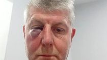 Escándalo en La Pampa: un árbitro expulsó a un jugador y le rompió la nariz y un ojo de una trompada. Escándalo en La Pampa: un árbitro expulsó a un jugador y le rompió la nariz y un ojo de una trompada.