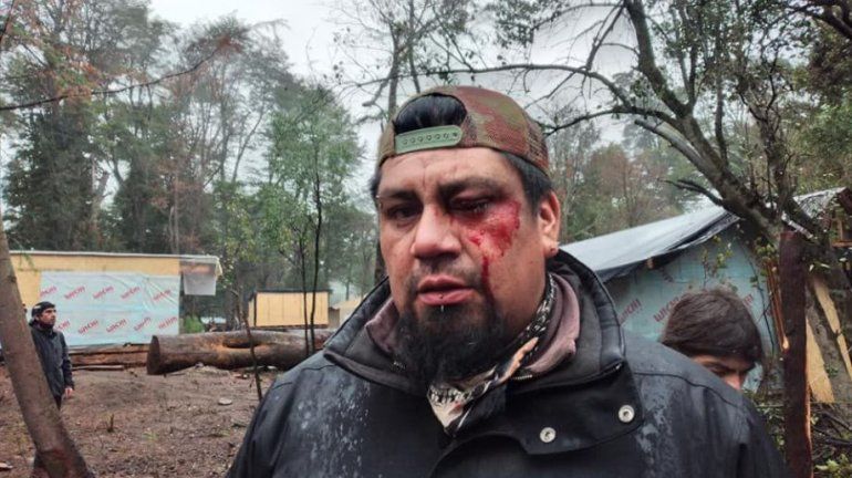 Uno de los vecinos de la toma herido por la Policia.
