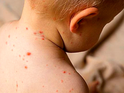 Argentina confirma casos de sarampión y Chile lanza una alerta epidemiológica. Argentina confirma casos de sarampión y Chile lanza una alerta epidemiológica.