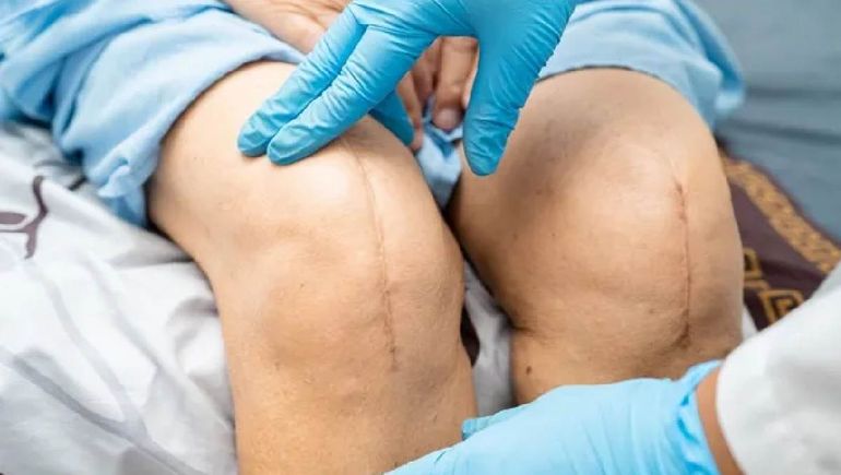 El tornillo utilizado para cirugías de rodilla fue prohibido por ANMAT por presentar irregularidades en su registro.