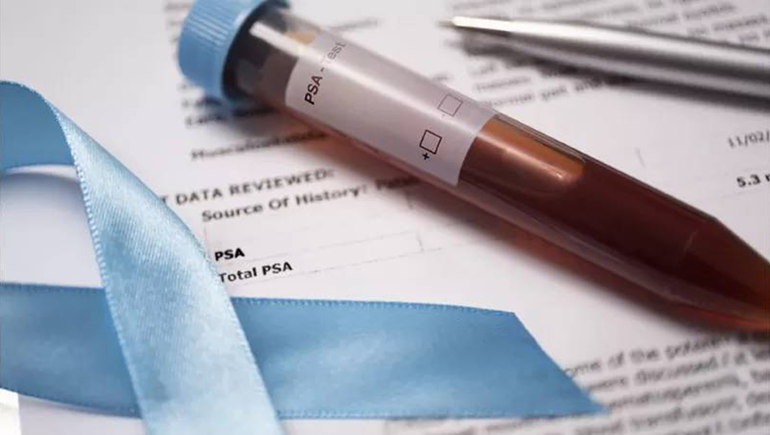 Hallazgo vincula bacterias con el cáncer de próstata