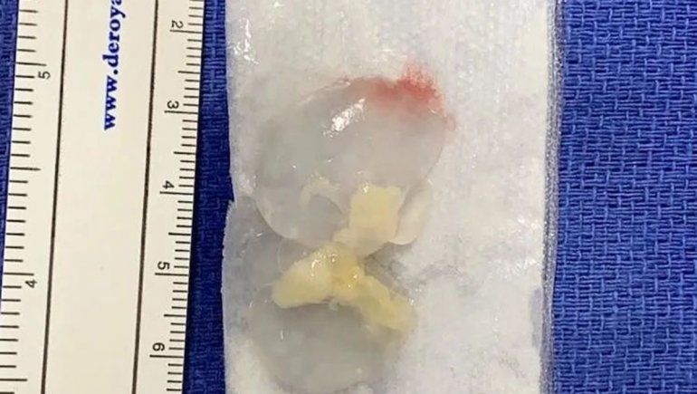 Gusano cerebro fútbol.