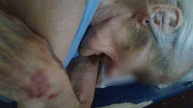 Moretones en el brazo de una de las ancianas internadas.