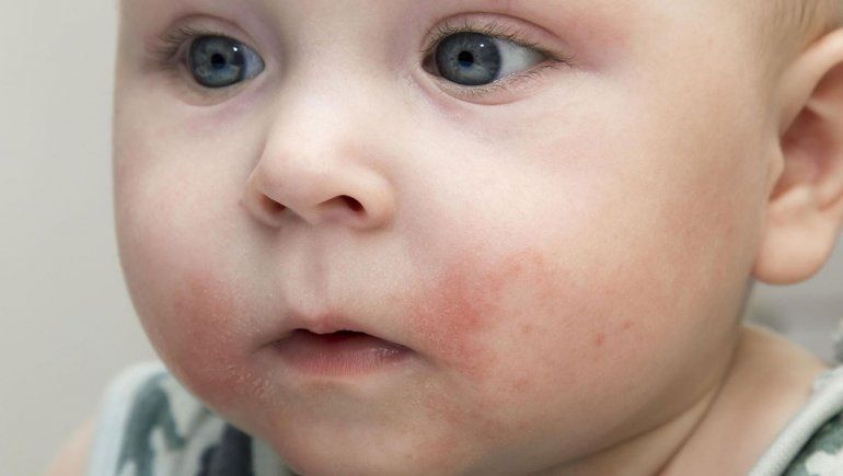 Alergias al comer: las que más afectan