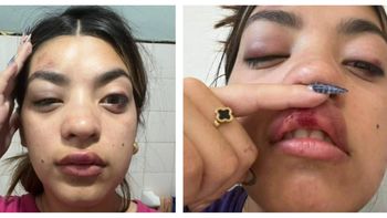 La joven mostró las consecuencias del ataque que sufrió en la disco Samsara y luego en la avenida San Martín, de Trelew. La joven mostró las consecuencias del ataque que sufrió en la disco Samsara y luego en la avenida San Martín, de Trelew.