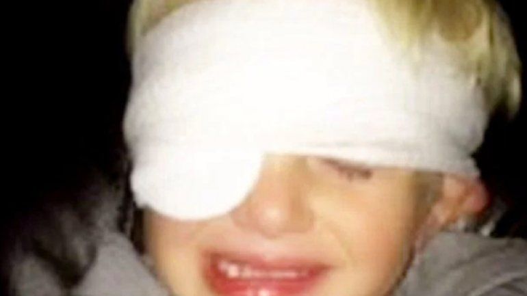 El pegamento le cayó en el ojo y se le despegó a los cinco días.&nbsp;