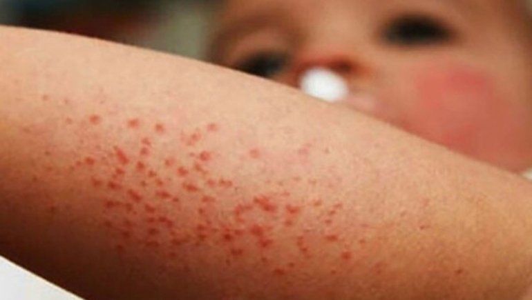 Los especialistas advierten que podrían encontrarse más casos de sarampión en los próximos días.