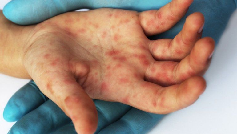 El sarampión avanza en Argentina. El sarampión avanza en Argentina.