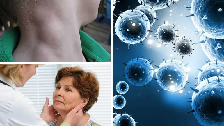 Recomienda realizarse chequeos para detectar linfomas. Recomienda realizarse chequeos para detectar linfomas.