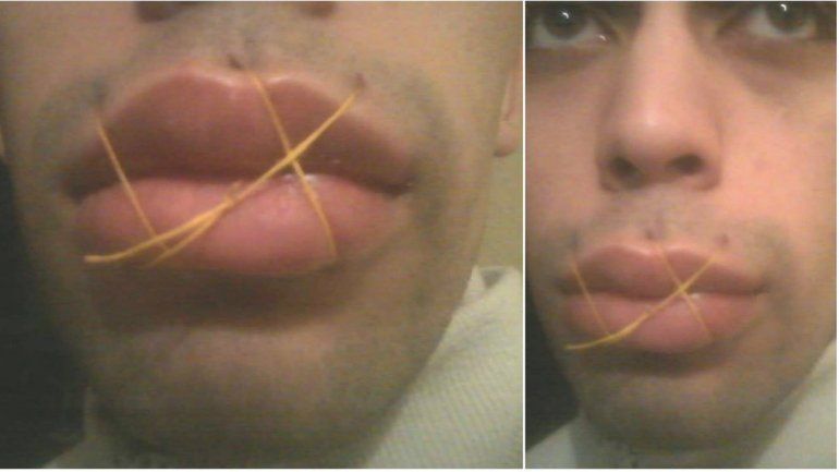 Preso cipoleño se cosió la boca para pedir un traslado