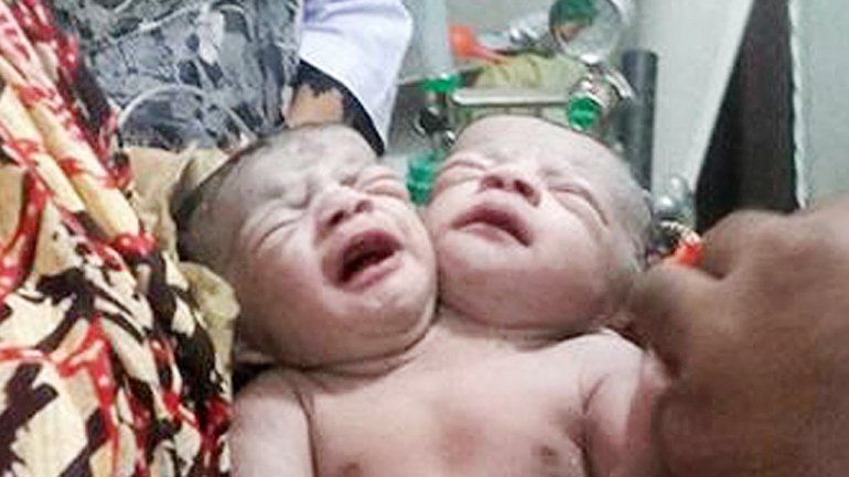 Imagen de la niña con dos cabezas difundida por el hospital de Daca.