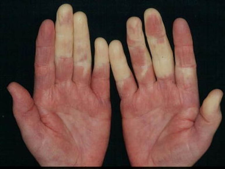 Si la vasoconstricción es constante y no se debe al frío, puede generar daño en los tejidos por falta de oxigenación sostenida. Si la vasoconstricción es constante y no se debe al frío, puede generar daño en los tejidos por falta de oxigenación sostenida.