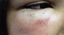 Una menor fue brutalmente golpeada en el colectivo - Parte de las heridas que recibió. 