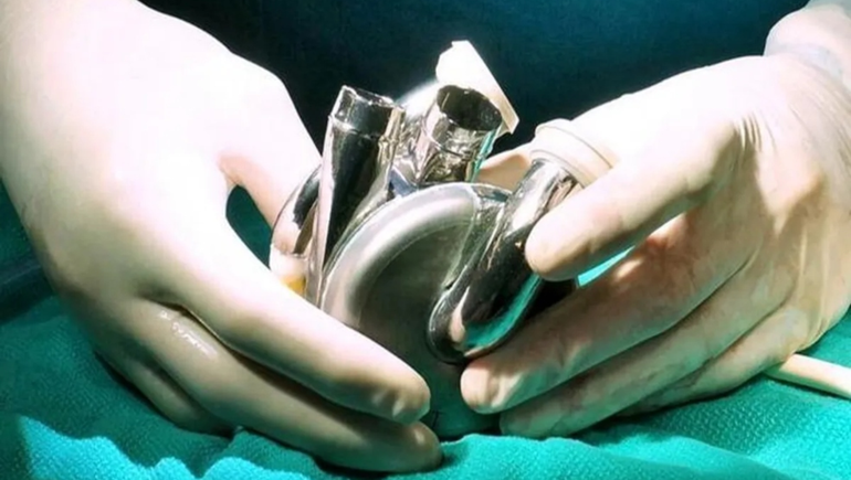 Avance médico: gracias a un corazón artificial de titanio, un hombre vivió más de 100 días