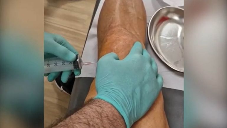Escalofriante: Ibrahimovic difundió imágenes de su tratamiento de rodilla