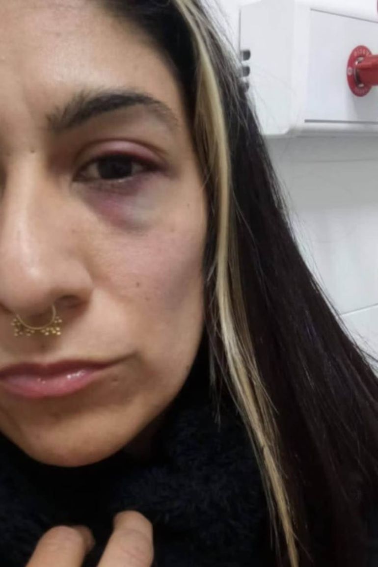 La mujer terminó con un golpe en uno de sus ojos y tuvo que ser atendida en un hospital. La mujer terminó con un golpe en uno de sus ojos y tuvo que ser atendida en un hospital.