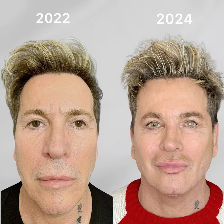 El antes y después de Guido Süller. El antes y después de Guido Süller.