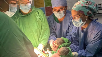 Las bebés compartían placenta y nacieron por cesárea programada a las 34 semanas de gestación. Las bebés compartían placenta y nacieron por cesárea programada a las 34 semanas de gestación.