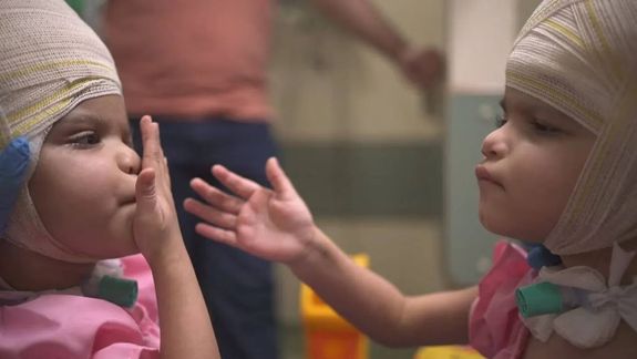 Las siamesas separadas en Brasil se recuperan favorablemente tras 27 horas de cirugía.