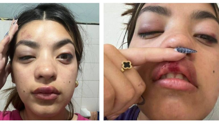 La joven mostró las consecuencias del ataque que sufrió en la disco Samsara y luego en la avenida San Martín