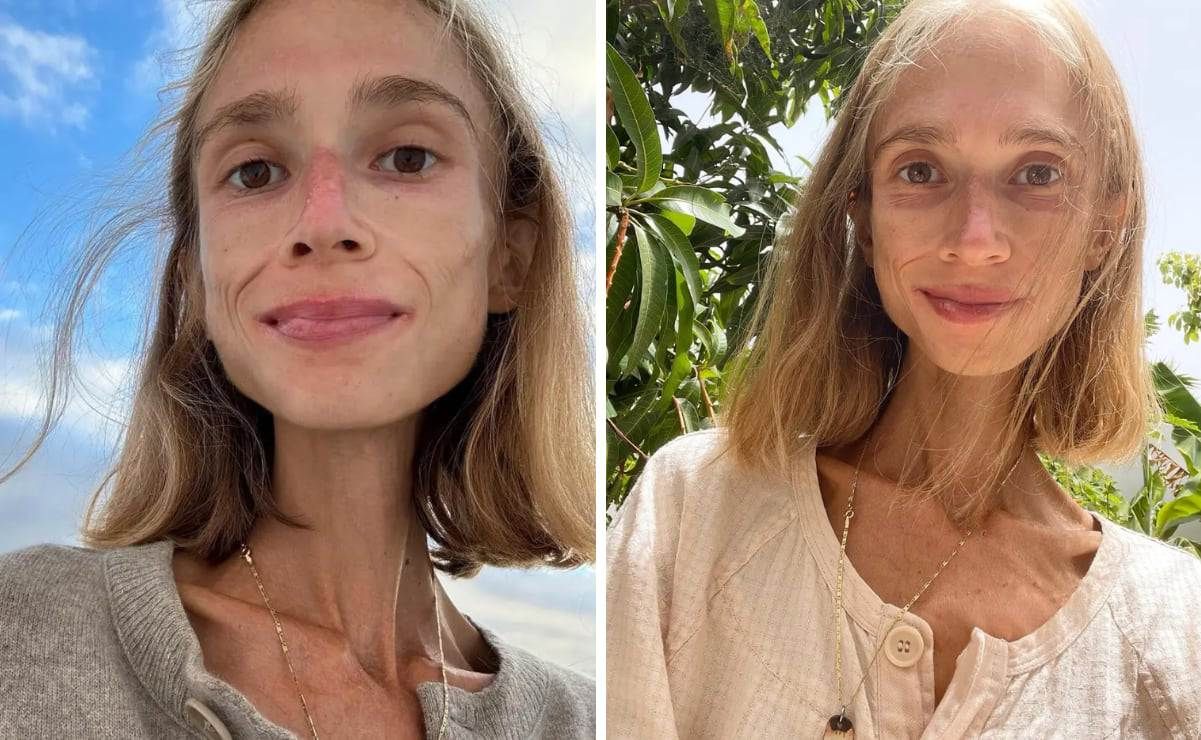 Tras seguir la dieta frigívora, Karolina Krzyak muere por desnutrición a los 27 años. Pesaba apenas 22 kilos.