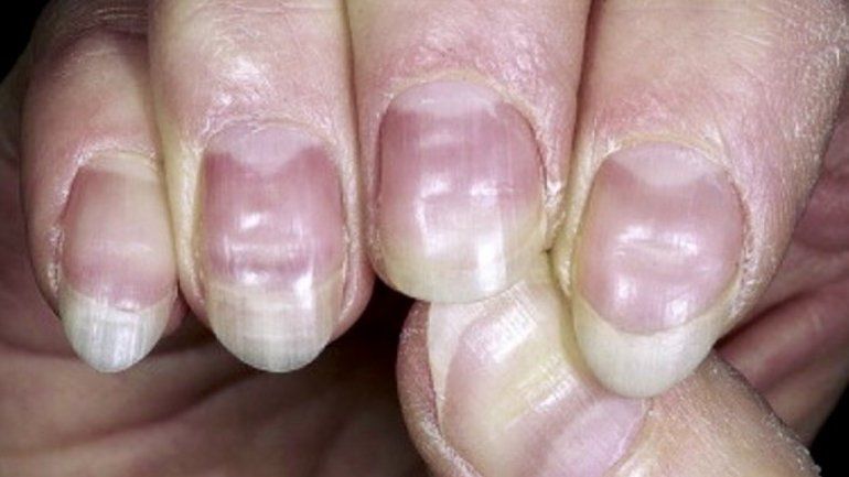 ¿Cómo saber si ya tuve covid-19?