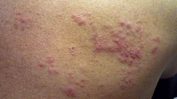 herpes z (1).jpg