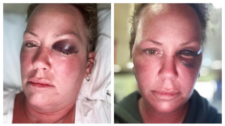 De vuelta en Ontario, donde reside, la turista canadiense habló con un medio local. Todavía tenía secuelas en su ojo producto del puñetazo.