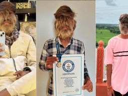 El joven de 18 años logró un récord mundial por su rostro peludo
