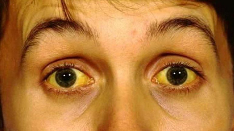 Cómo se transmiten y se previenen los tipos de hepatitis virales