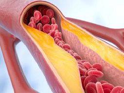 Los accidentes cerebrovasculares (ACV) e infartos son las principales causas de muerte en el mundo. Los accidentes cerebrovasculares (ACV) e infartos son las principales causas de muerte en el mundo.