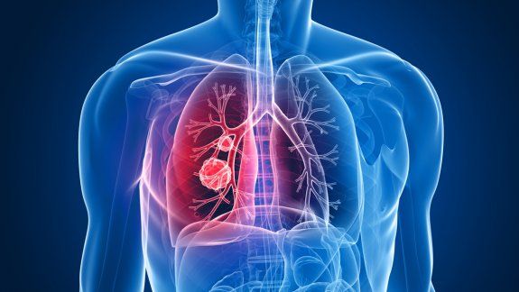 Los tipos de cáncer que más afectan  a los argentinos