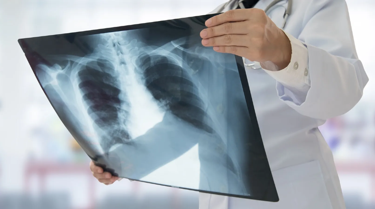 Tuberculosis: ¿por qué están aumentando los casos en Neuquén?